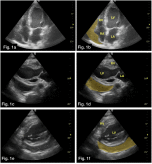Pericardial decompression syndrome: A complication of pericardiocentesis
