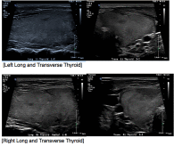 Difficult diagnosis: A case report of thyroid storm obscured by acute asthma exacerbation and concurrent H1N1 influenza