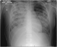 Young patient with pneumonia complicated by bronchopleural fistula