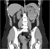 Renal angiomyolipoma rupture in a young female with COVID-19