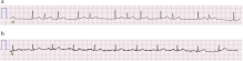 Clinical relationship between blood concentration and clinical symptoms in aconitine intoxication