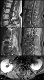 Spontaneous infarction of lumbar roots, vertebrae and paravertebral muscles