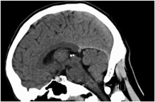 Pituitary apoplexy in the setting of COVID-19 infection: A case report