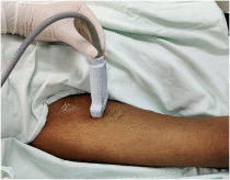 Use of ‘Low approach’ femoral central venous cannulation during COVID 19 pandemic