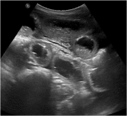 More than just gastritis: An unusual presentation of strangulated transmesenteric hernia in a pediatric patient