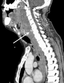 Retropharyngeal hematoma in a patient with chronic alcoholism