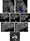 Atypical COVID–19 presentation with Budd-Chiari syndrome leading to an outbreak in the emergency department