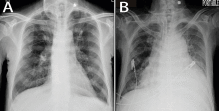 Gastropericardial fistula induced acute purulent pericarditis