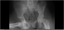 Inferior hip dislocation in a 16 year old