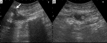 Urachal abscess: a cause of adult abdominal pain that cannot be ignored