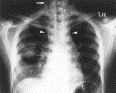 Descending necrotizing mediastinitis from upper respiratory infection