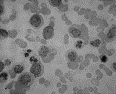 Hyperleukocytosis presenting as myocardial ischemia, altered sensorium, and metabolic acidosis