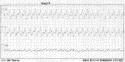 Rate-related bundle branch block: an uncommon wide complex tachycardia