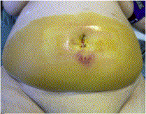 Choloperitoneum causes extensive coloring of the abdominal wall skin