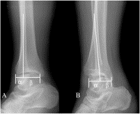 Assessment of Bosworth-type fracture by external oblique radiographs