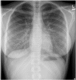 Cardiac myxoma as a mimic: a diagnostic challenge
