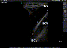 Usefulness of guidewire visualization during ultrasound-guided internal jugular vein cannulation