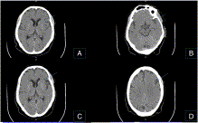 Good outcome after intravenous thrombolysis for acute stroke in a patient under treatment with dabigatran