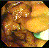 Hookworm infestation as unexpected cause of recurrent pancreatitis