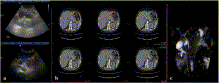 Acute pancreatitis due to extracorporeal shock wave lithotripsy: a rare complication
