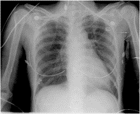 Life-threatening hemothorax due to azygos vein rupture after chest compression during cardiopulmonary resuscitation