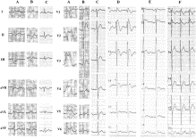 ST-segment elevation after direct current shock mimicking acute myocardial infarction: a case report and review of the literature