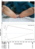 Serial monitoring of sedation scores in benzodiazepine overdose