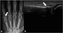 Accuracy of bedside ultrasonography for the diagnosis of finger fractures
