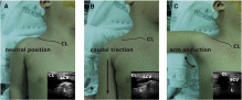 Influence of caudal traction of ipsilateral arm on ultrasound image for supraclavicular central venous catheterization