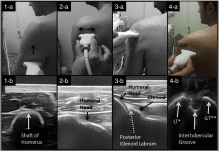 Point-of-care ultrasonography for the management of shoulder dislocation in ED