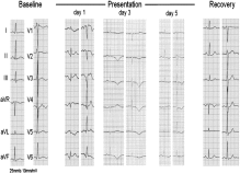 The pivotal role of a pre-admission electrocardiogram for the diagnosis of Takotsubo syndrome in the ED