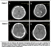 Hemodynamic challenges in traumatic subarachnoid hemorrhage complicated by cerebral vasospasm