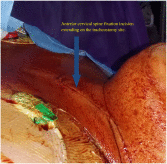 Percutaneous tracheostomy in post–cervical spine fixation patients: challenging the dogma