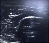 Novel technique in ED: supracondylar ultrasound-guided nerve block for reduction of distal radius fractures